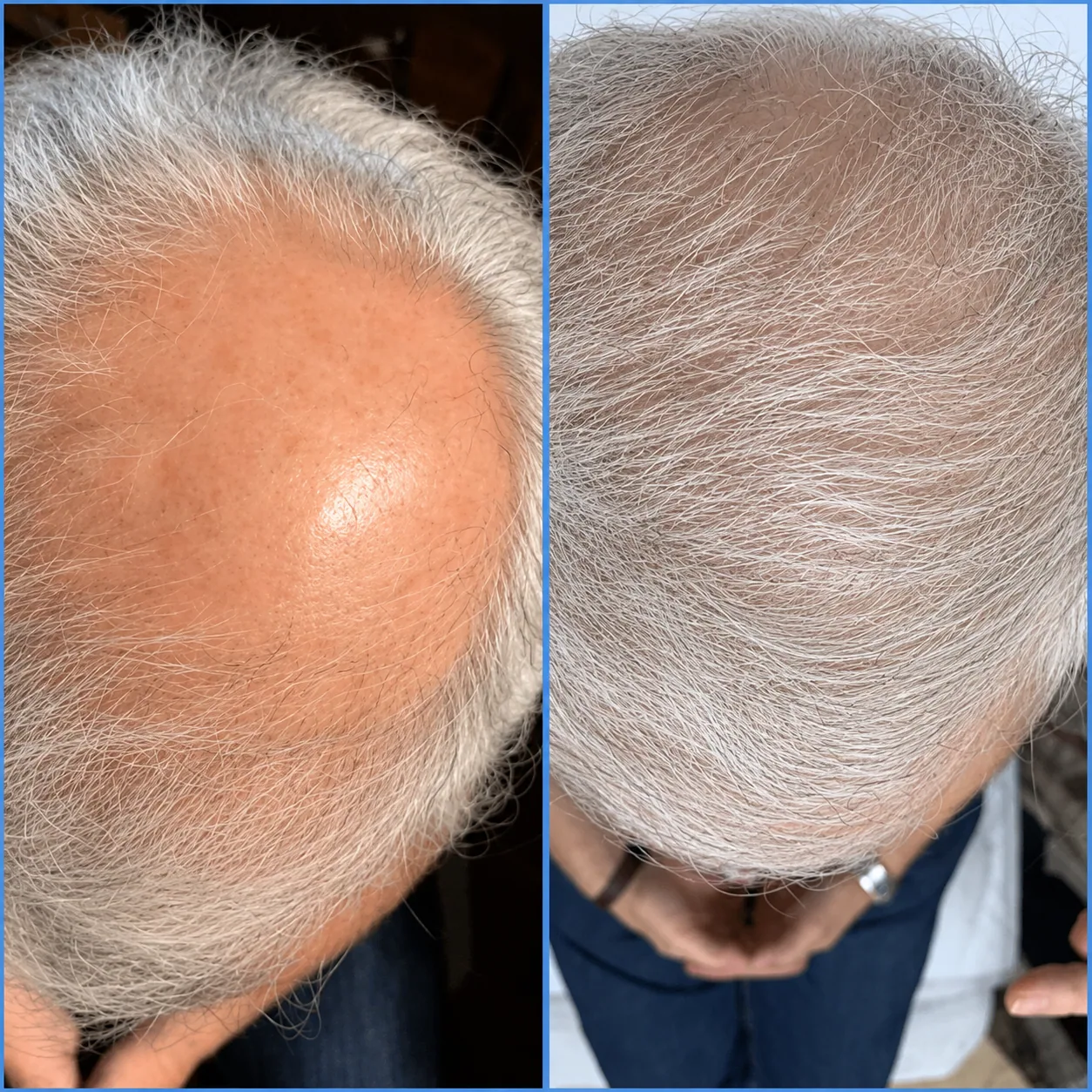 Hair Restoration
