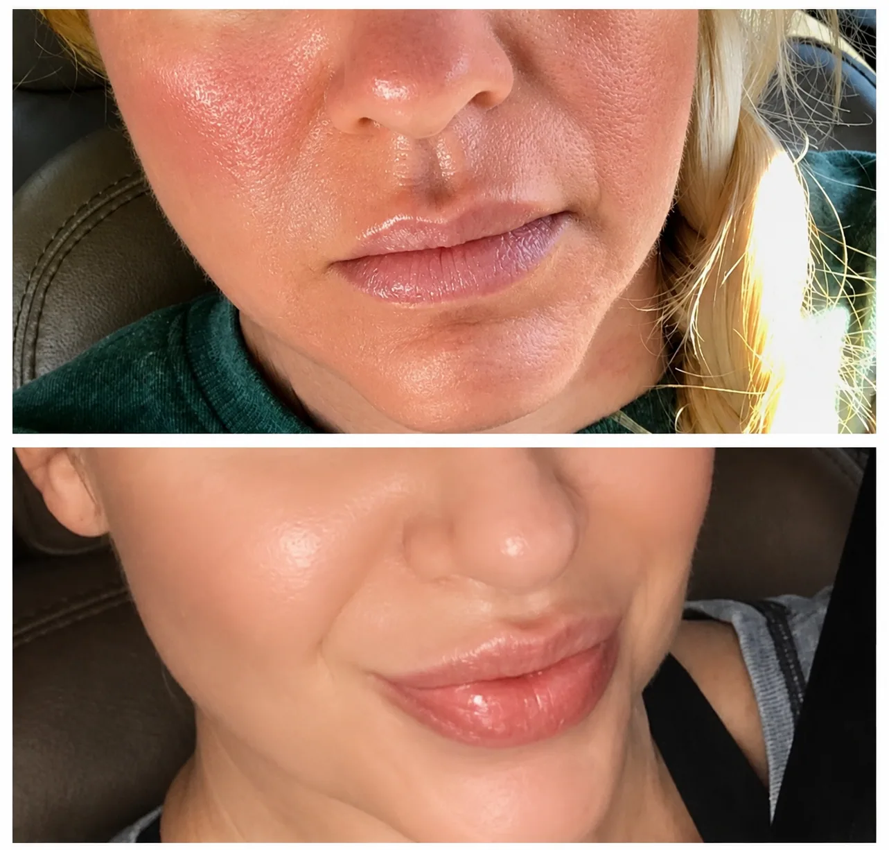 Laser Peels