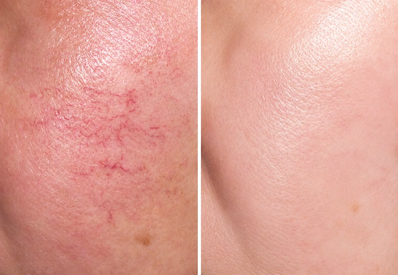 Rosacea Treatment