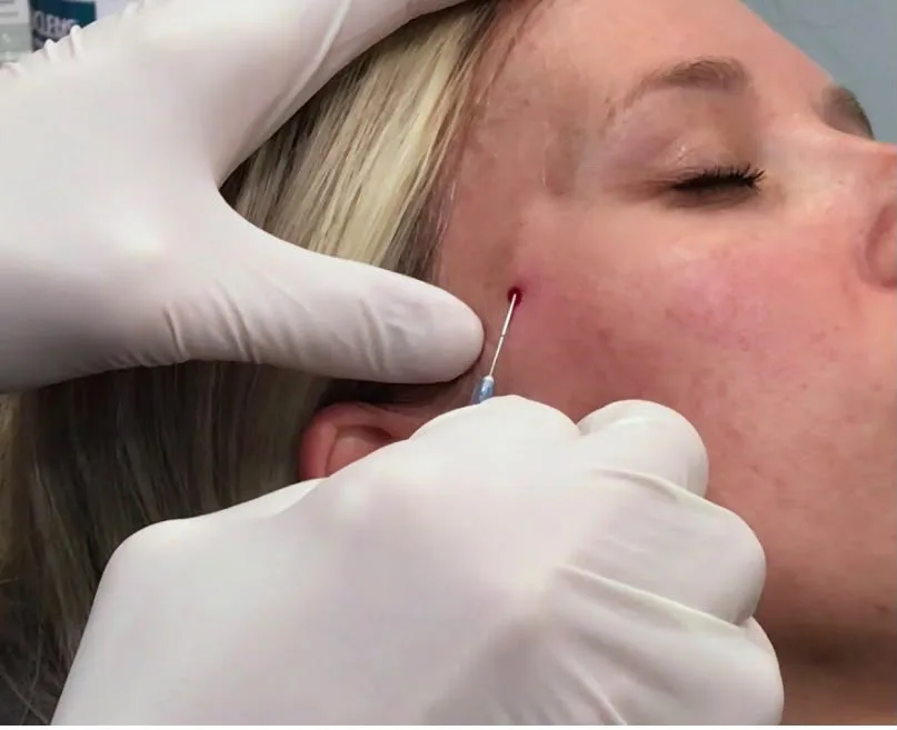 Temporal Fillers