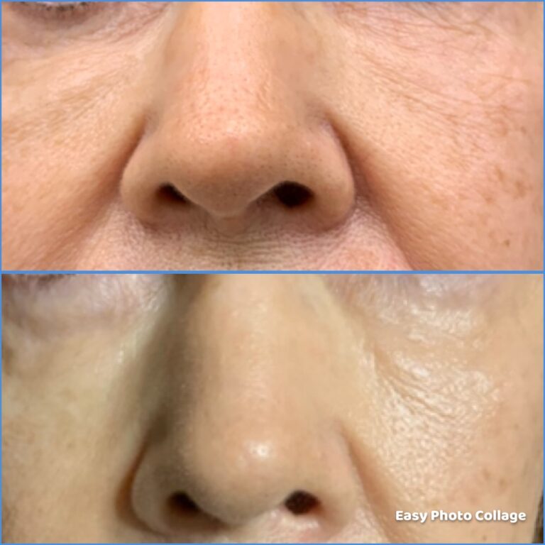 Butex Medical spa and Laser Treatment Facelift Results