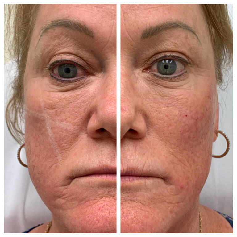 Butex Medical spa and Laser Treatment Fillers