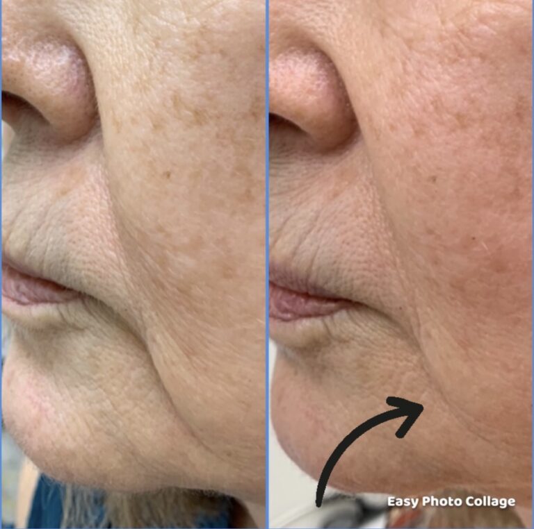 Butex Medical spa and Laser Treatment Laser Face Lift