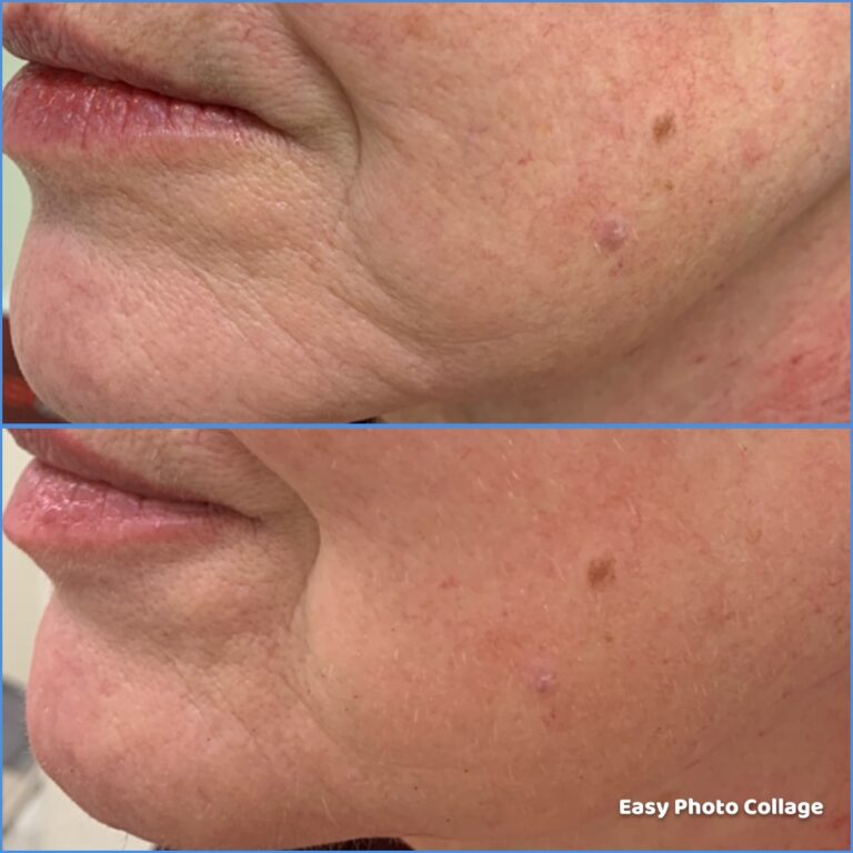 Butex Medical spa and Laser Treatment Laser Face Lift Results