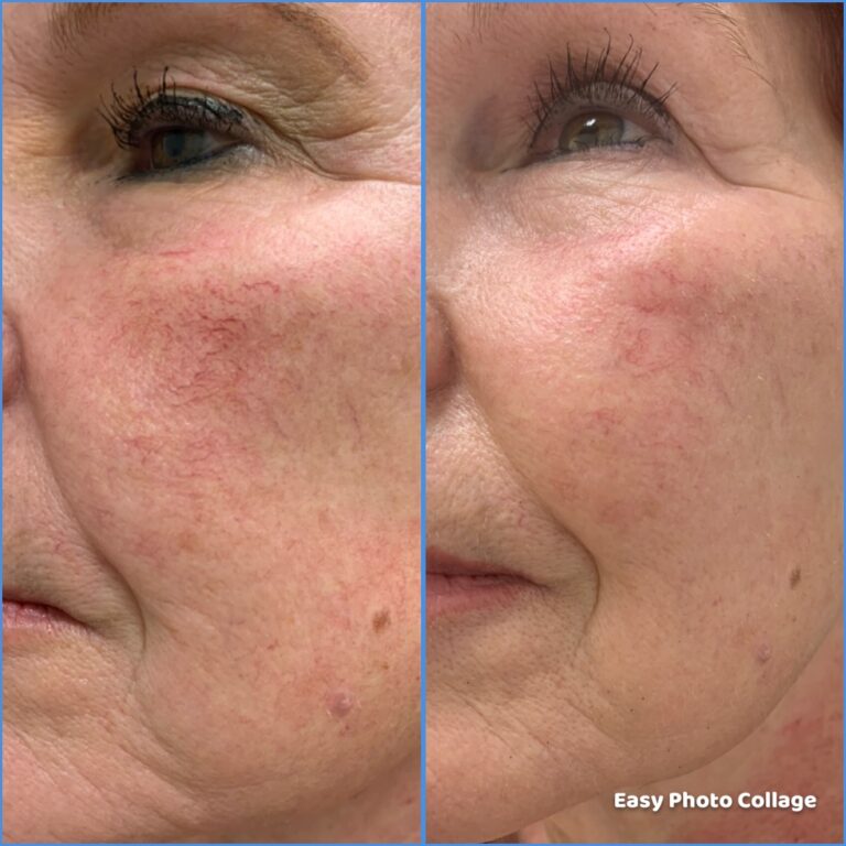 Butex Medical spa and Laser Treatment Laser Facelift