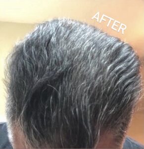 Butex Medical spa and Laser Treatment Laser Hair Treatment After