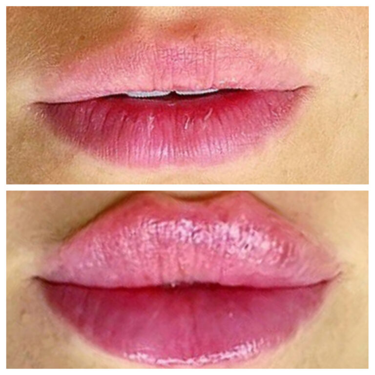 Butex Medical spa and Laser Treatment Lip Filler