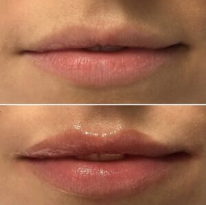 Butex Medical spa and Laser Treatment LipLase