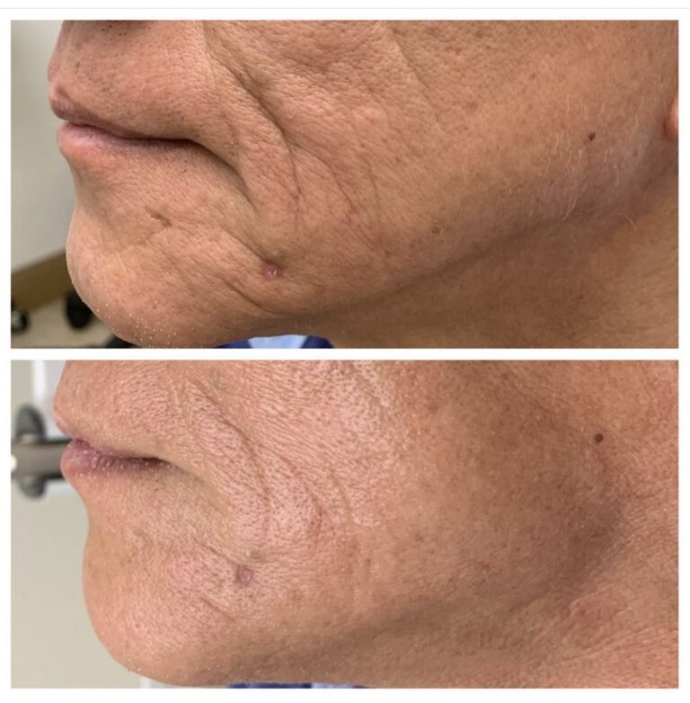 Butex Medical spa and Laser Treatment Non surgical Facelift