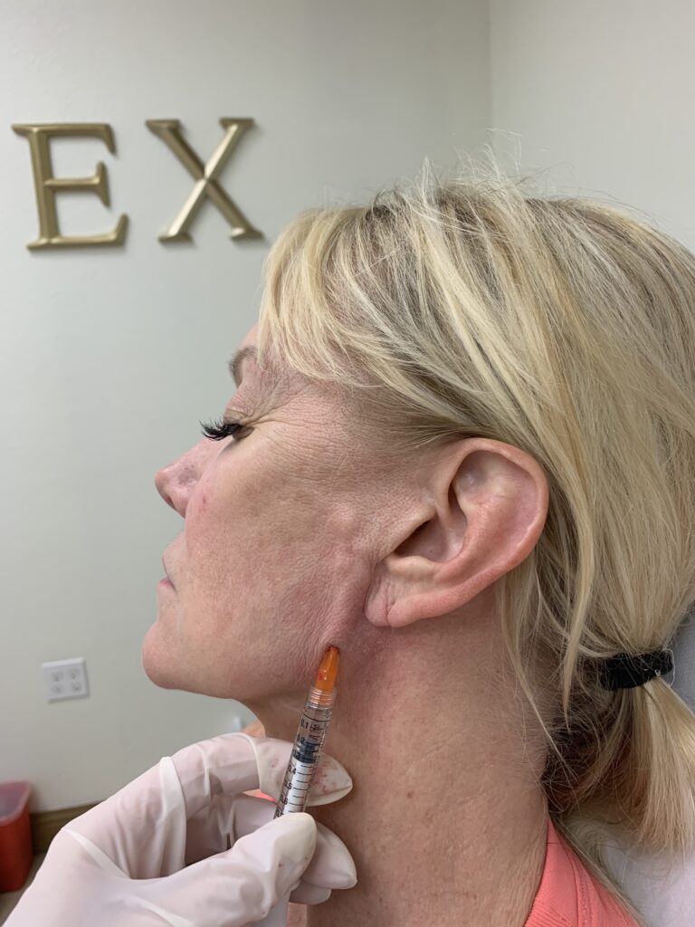 Butex Medical spa and Laser Treatment PDO Thread