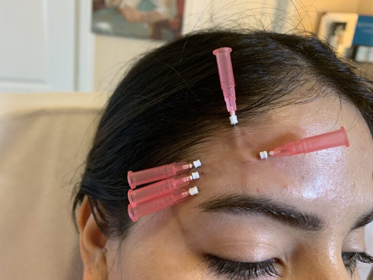 Butex Medical spa and Laser Treatment PDO Threads