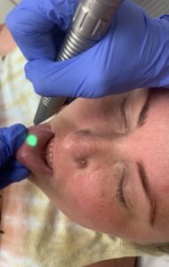 Butex Medical spa and Laser Treatment Professional Lip Treatment