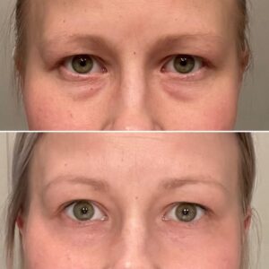 Butex Medical spa and Laser Treatment SmoothEye Before After