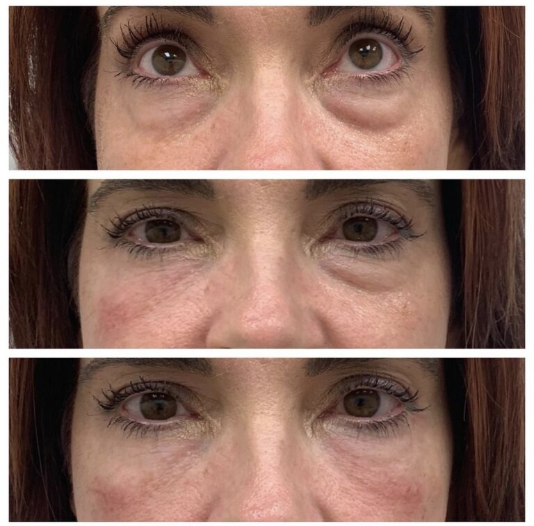 Butex Medical spa and Laser Treatment Tear Trough Treatment