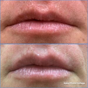 Butex Medical spa and Laser Treatment Top Lip Laser