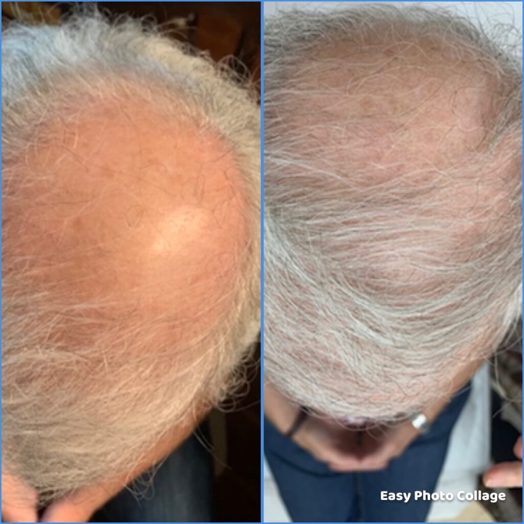 Laser Therapy for Hairloss  Tigard Life