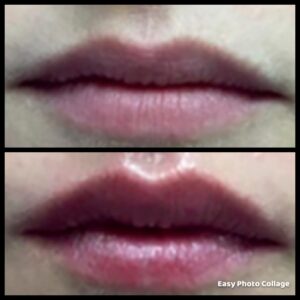 lip before and after
